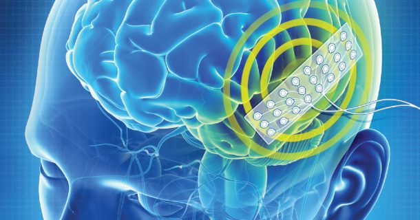 Orion: implante cerebral pode fornecer percepção visual