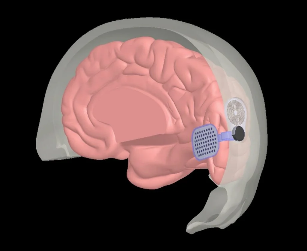 Orion: implante cerebral pode fornecer percepção visual