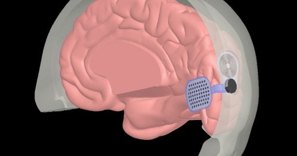 Orion: implante cerebral pode fornecer percepção visual