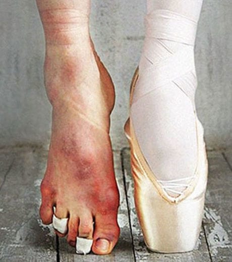 foto de comparativo entre pés de bailarina