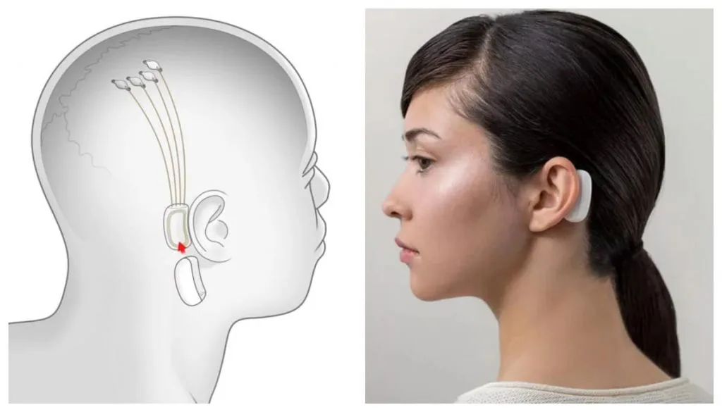 dispositivo da neuralink atrás da orelha de mulher
