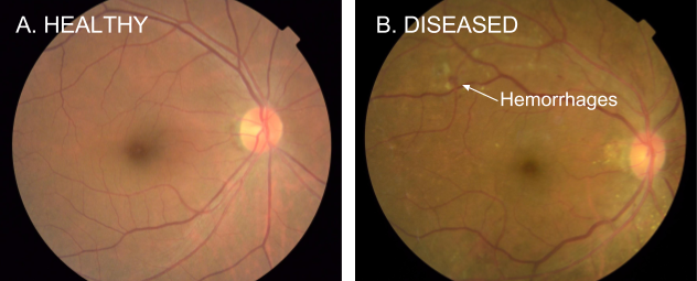 Comparação entre retina saudável e condição de retinopatia diabética. Imagem: Google Health.